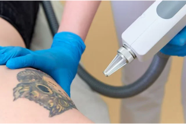 Tattoo Removal Aftercare