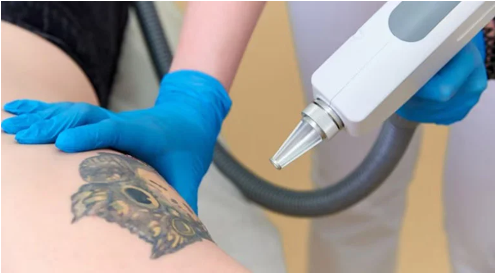 Tattoo Removal Aftercare