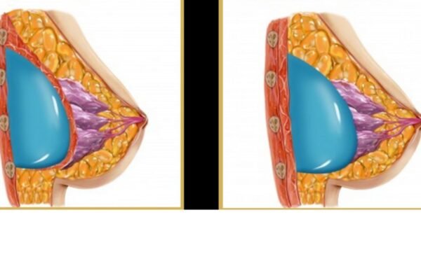 Breast Enlargement Cost