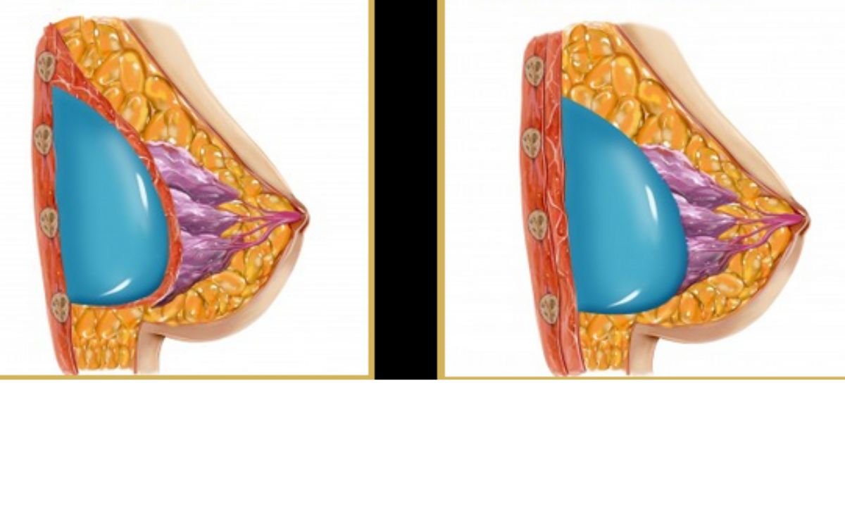 Breast Enlargement Cost