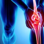 Joint Replacement Surgery